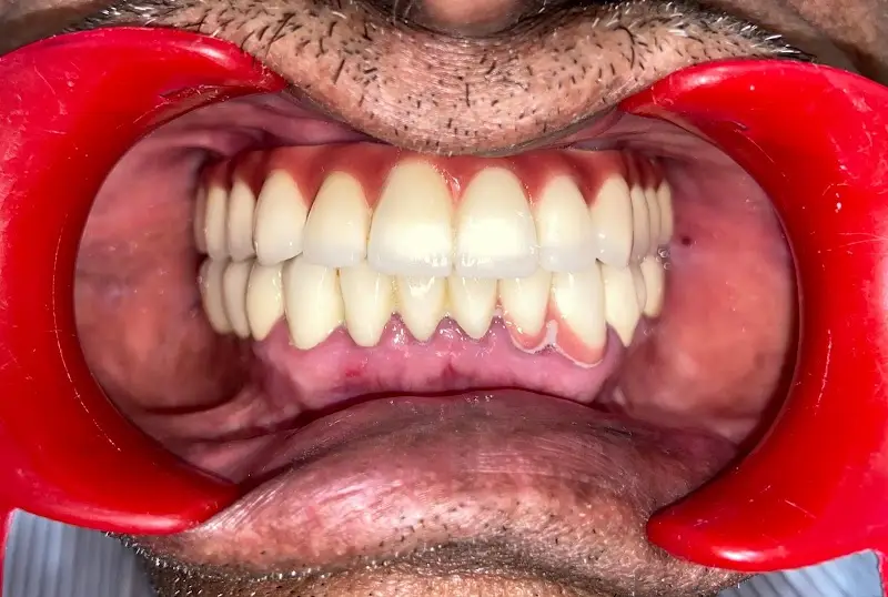 PATEL DENTAL ORTHODONTIC AND DENTAL IMPLANT CENTER - Dental Clinic in Bengaluru